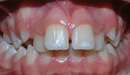 Twin block Invisalign