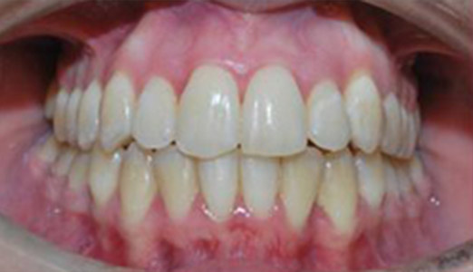 Invisalign treatment