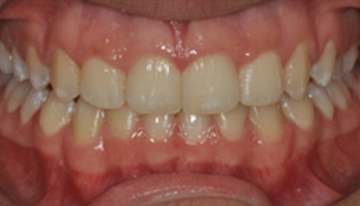 Twin block Invisalign