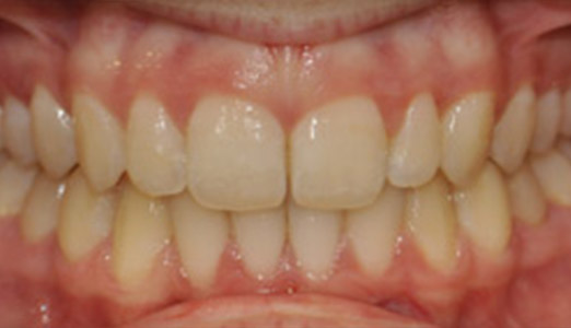 Twin block Invisalign