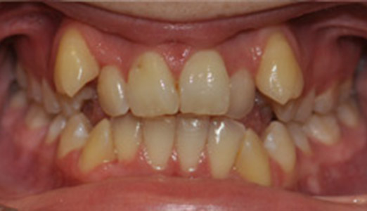 Adult full fixed and Invisalign