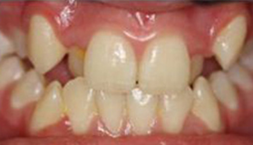 Invisalign treatment