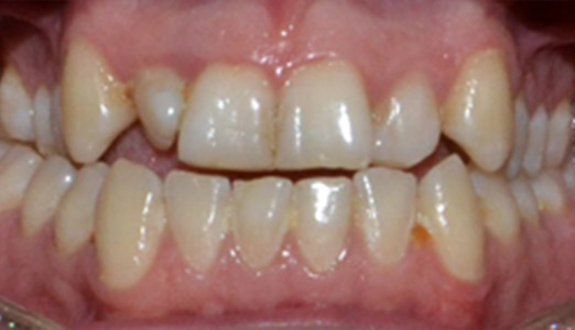 Adult Invisalign