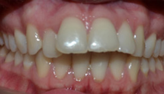 Adult Invisalign