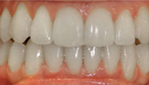 Invisalign treatment