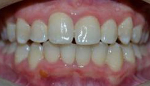 Invisalign treatment