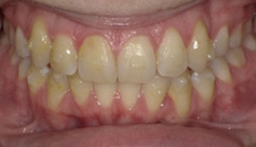 Adult full fixed and Invisalign