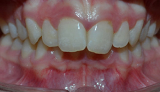 Twin block Invisalign