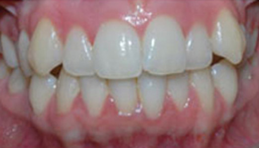 Invisalign treatment