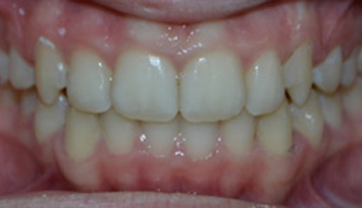 Invisalign