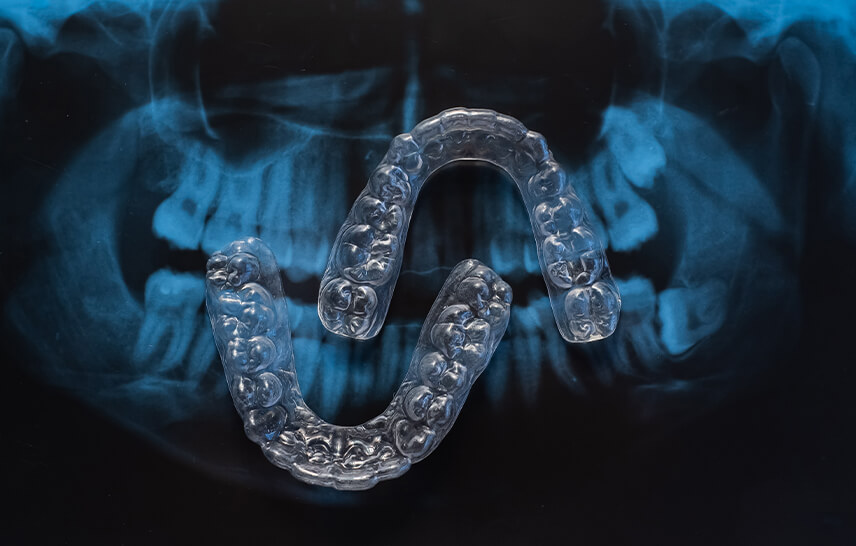 Mail Order Clear Aligners vs Specialist Orthodontist: Why Expert Care Matters for Your Smile