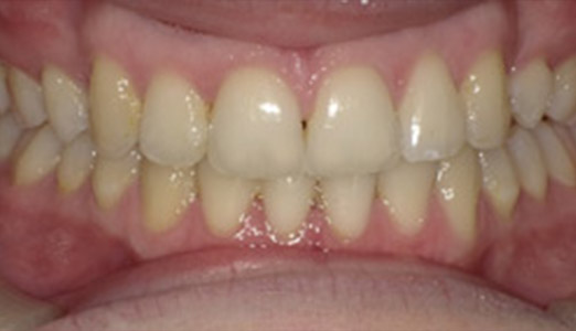 Adult Invisalign