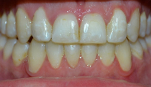 Adult Invisalign