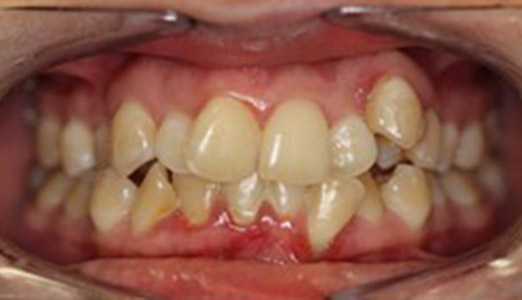 Invisalign treatment